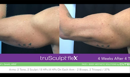 arm contouring toning before after mississauga oakville